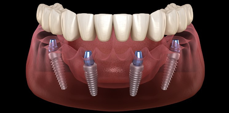 Особенности имплантации по методике all on 4